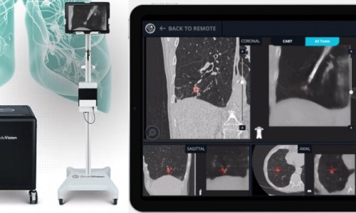Nawigacja Bronchoskopowa Body Vision